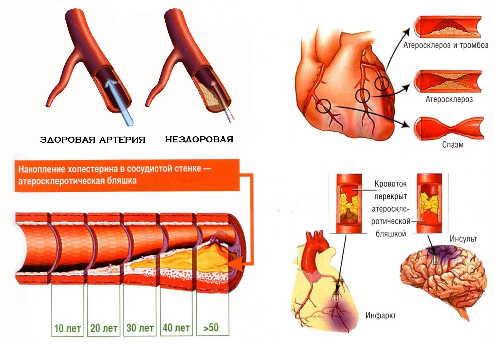 Здоровые и пораженные атеросклерозом артерии. Ангиоклинз борется с атеросклерозом.