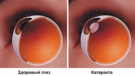 Здоровый глаз и глаз с катарактой